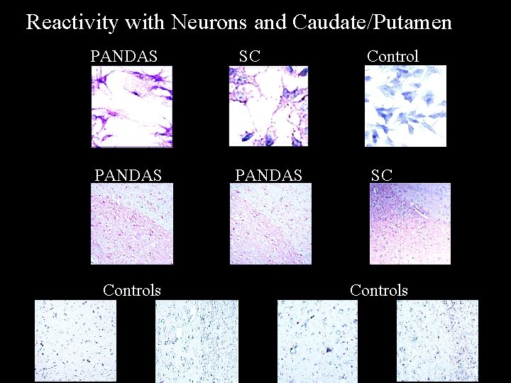 Reactivity with Neurons and Caudate/Putamen PANDAS SC Controls 
