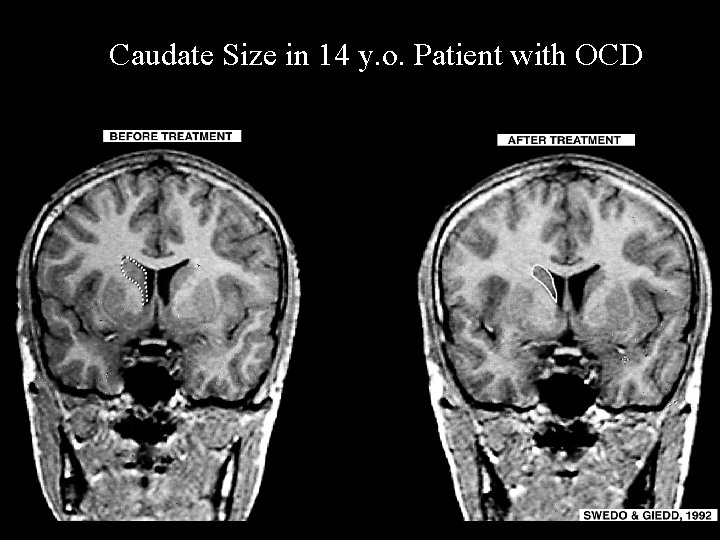 Caudate Size in 14 y. o. Patient with OCD 