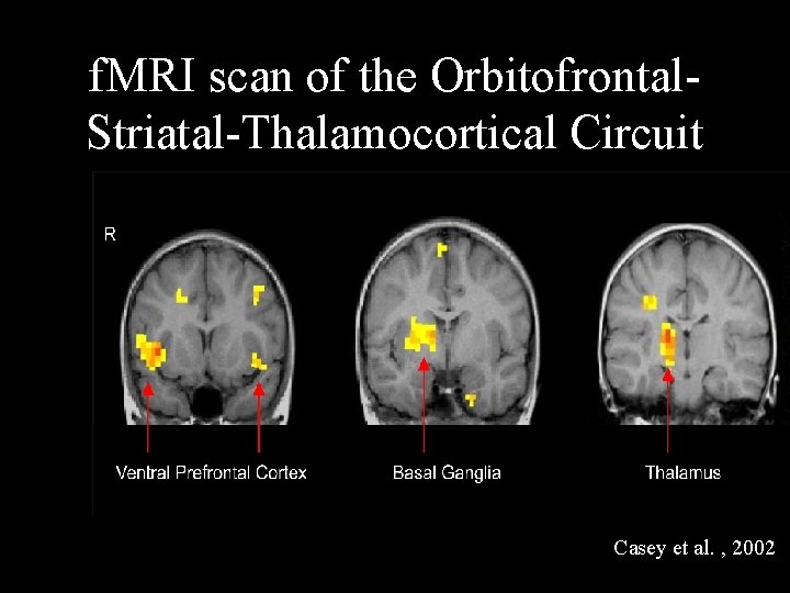 f. MRI scan of the Orbitofrontal. Striatal-Thalamocortical Circuit Casey et al. , 2002 