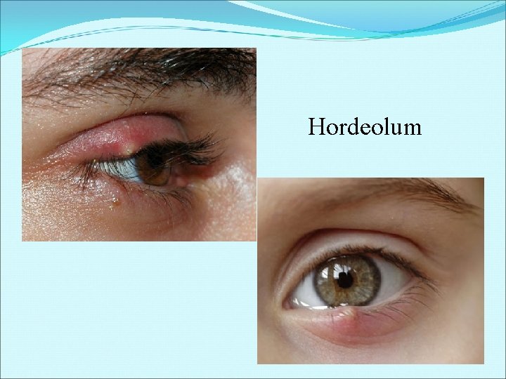  Hordeolum 