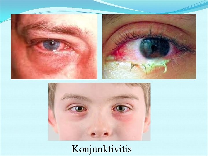 Konjunktivitis 