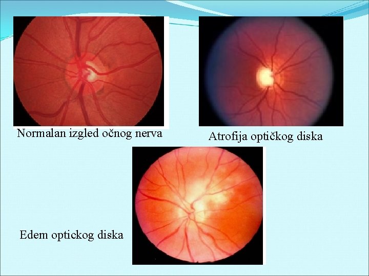 Normalan izgled očnog nerva Edem optickog diska Atrofija optičkog diska 