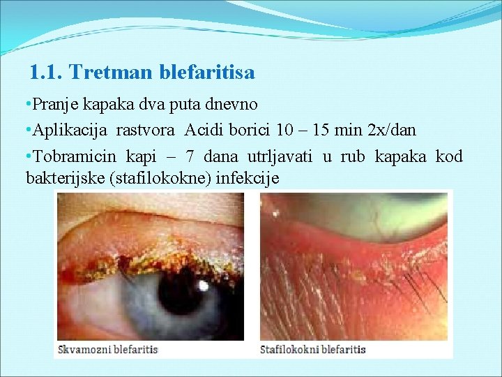 1. 1. Tretman blefaritisa • Pranje kapaka dva puta dnevno • Aplikacija rastvora Acidi