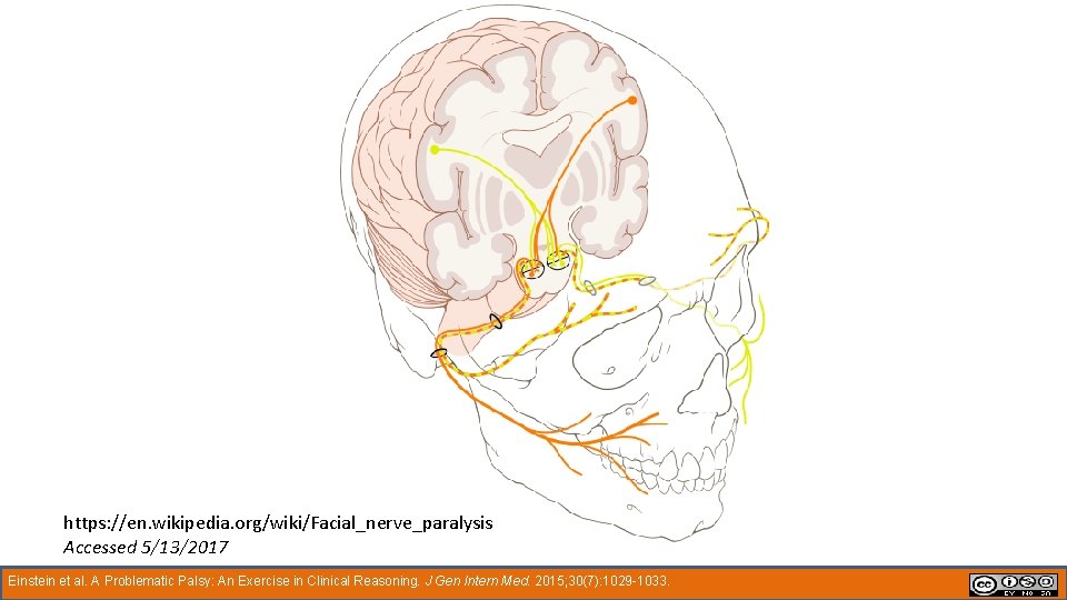 https: //en. wikipedia. org/wiki/Facial_nerve_paralysis Accessed 5/13/2017 Einstein et al. A Problematic Palsy: An Exercise