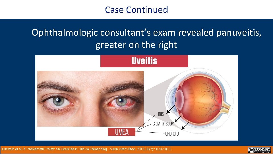 Case Continued Ophthalmologic consultant’s exam revealed panuveitis, greater on the right Einstein et al.