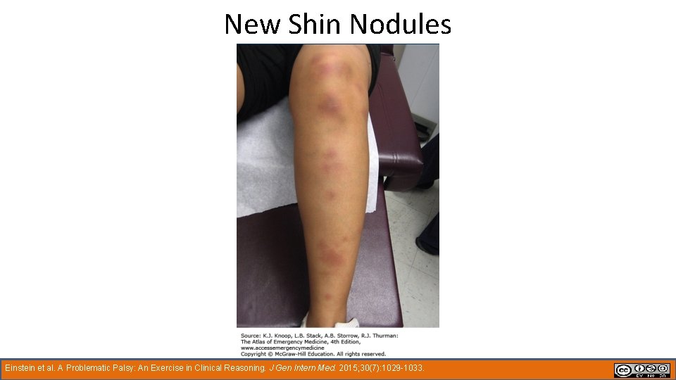 New Shin Nodules Einstein et al. A Problematic Palsy: An Exercise in Clinical Reasoning.