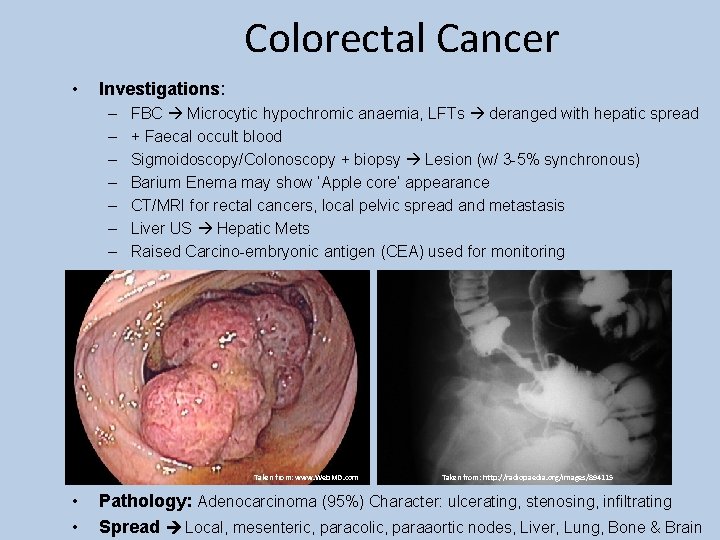 Colorectal Cancer • Investigations: – – – – FBC Microcytic hypochromic anaemia, LFTs deranged