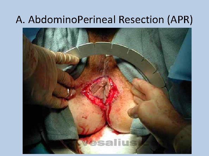 A. Abdomino. Perineal Resection (APR) 