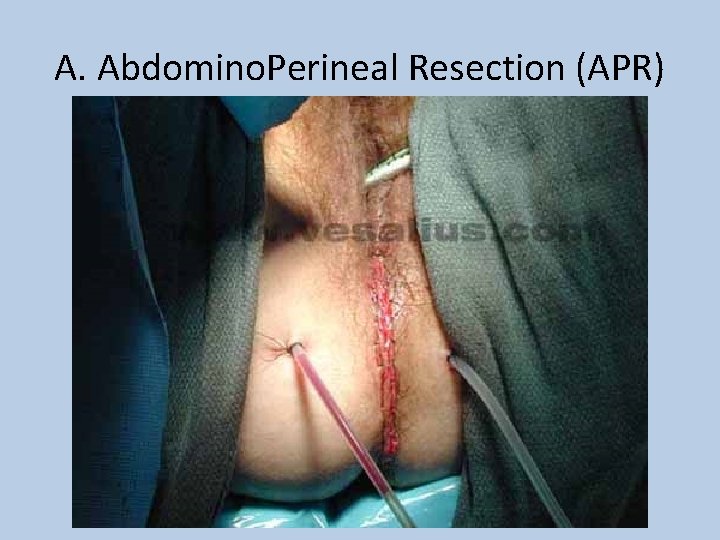 A. Abdomino. Perineal Resection (APR) 