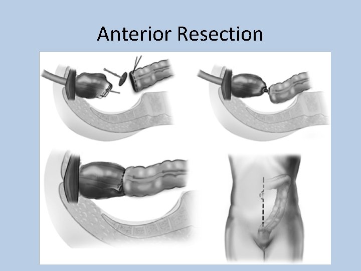 Anterior Resection 