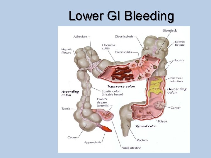 Lower GI Bleeding 