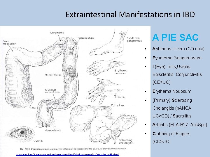 Extraintestinal Manifestations in IBD A PIE SAC • Aphthous Ulcers (CD only) • Pyoderma