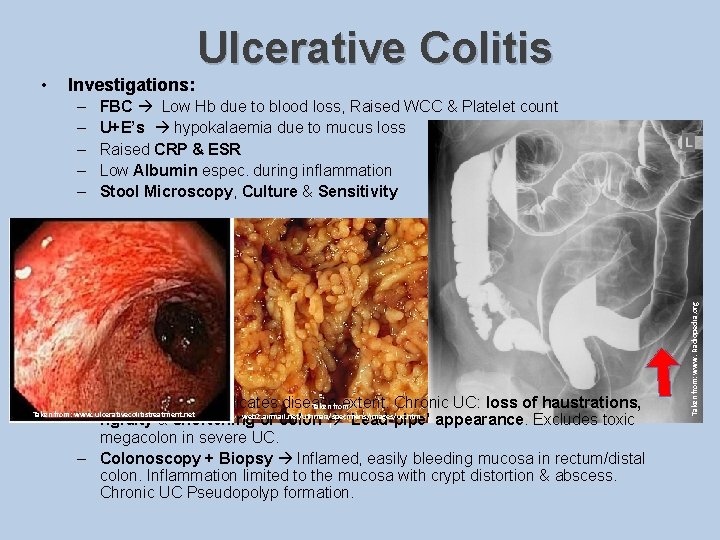  • Ulcerative Colitis Investigations: – – – FBC Low Hb due to blood
