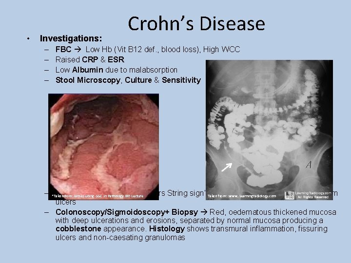  • Investigations: – – Crohn’s Disease FBC Low Hb (Vit B 12 def.