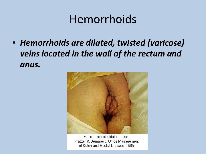 Hemorrhoids • Hemorrhoids are dilated, twisted (varicose) veins located in the wall of the