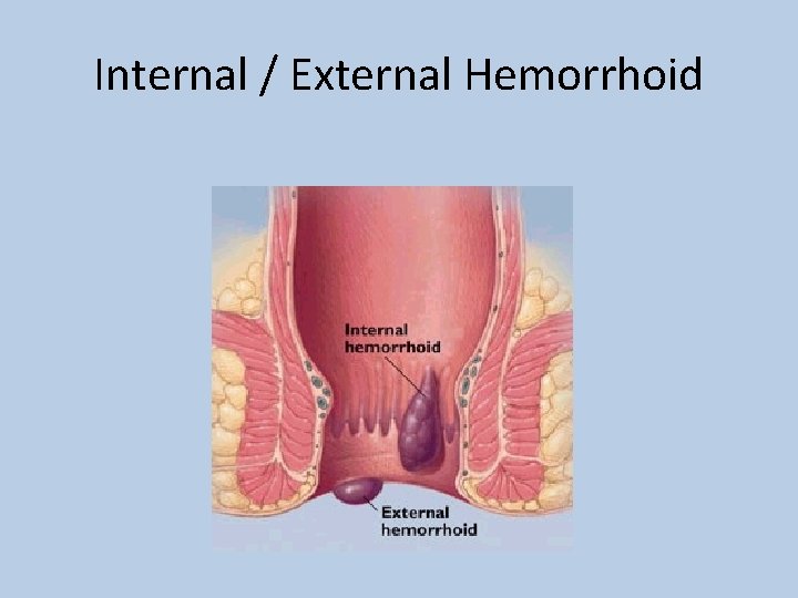 Internal / External Hemorrhoid 