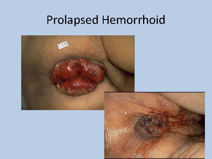 Prolapsed Hemorrhoid 