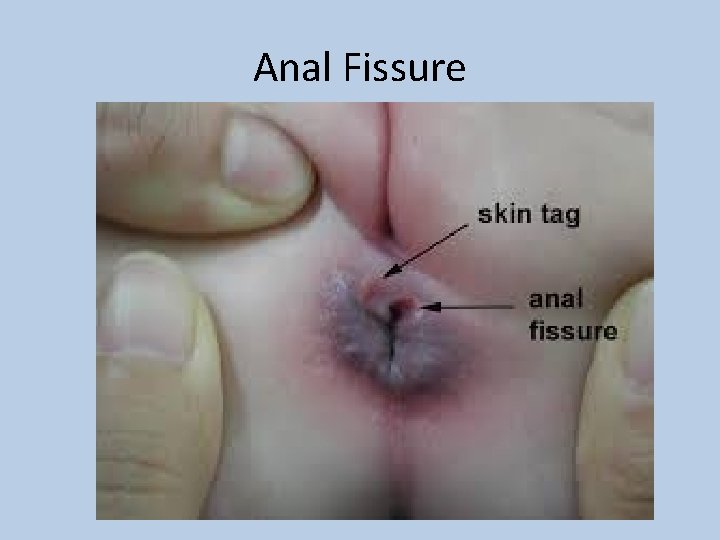 Anal Fissure 