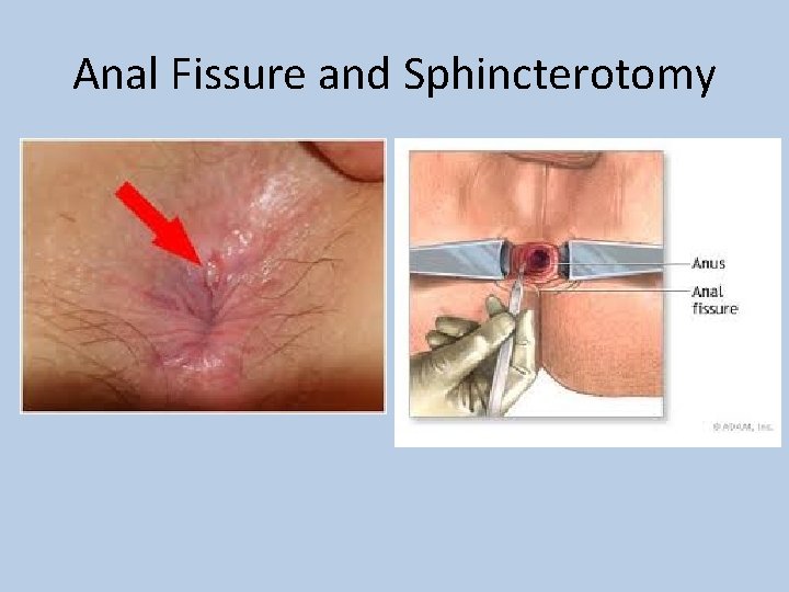 Anal Fissure and Sphincterotomy 