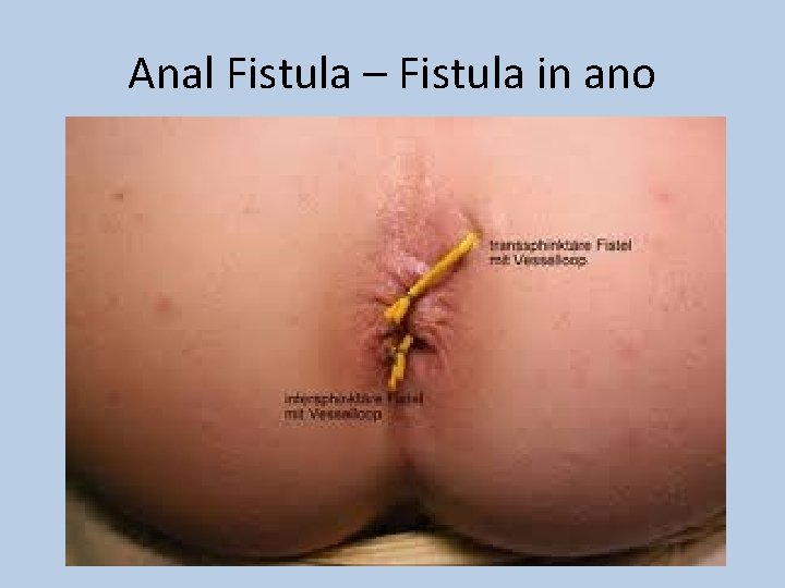 Anal Fistula – Fistula in ano 