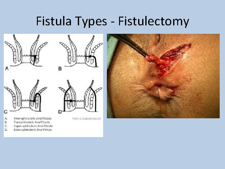 Fistula Types - Fistulectomy 