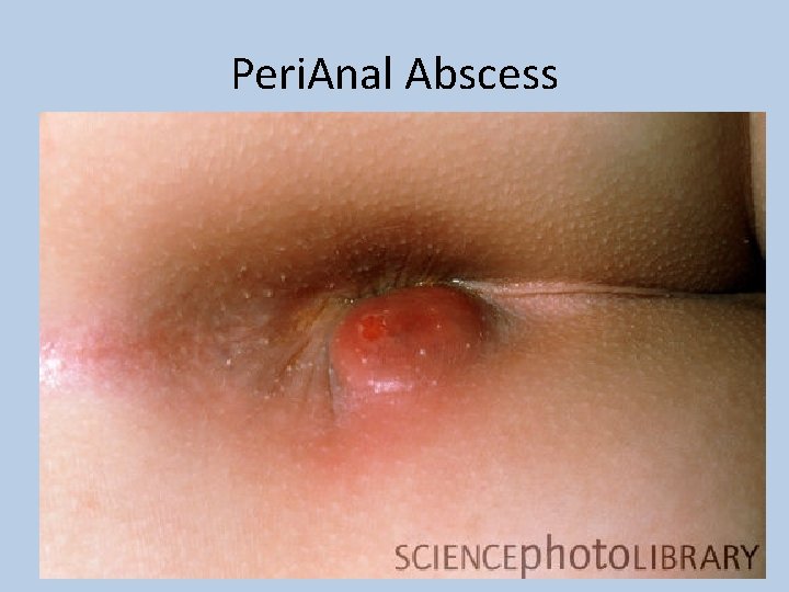 Peri. Anal Abscess 