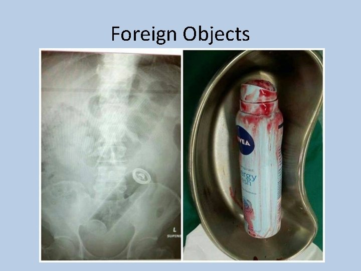 Foreign Objects 