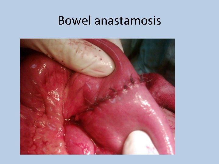 Bowel anastamosis 