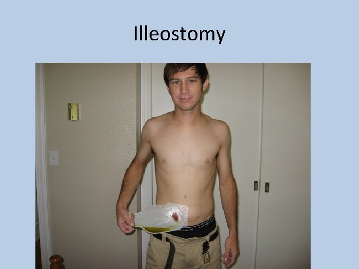 Illeostomy 