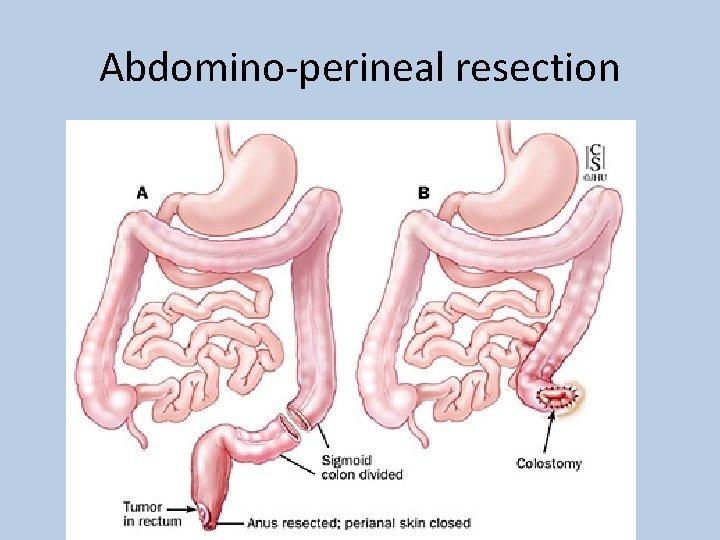 Abdomino-perineal resection 