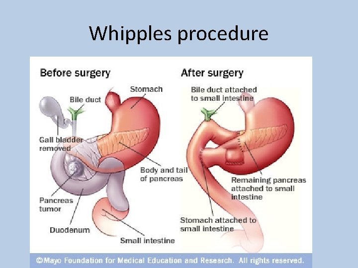 Whipples procedure 