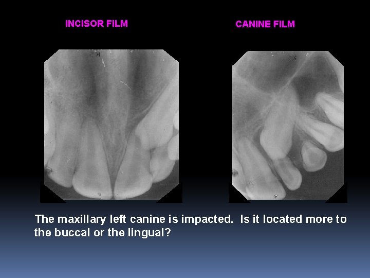 INCISOR FILM CANINE FILM The maxillary left canine is impacted. Is it located more