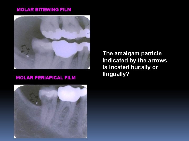 MOLAR BITEWING FILM MOLAR PERIAPICAL FILM The amalgam particle indicated by the arrows is