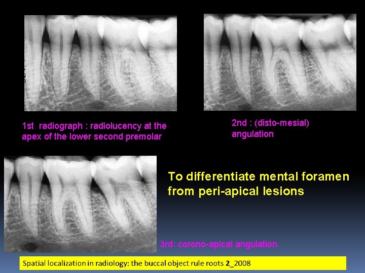 1 st radiograph : radiolucency at the apex of the lower second premolar 2