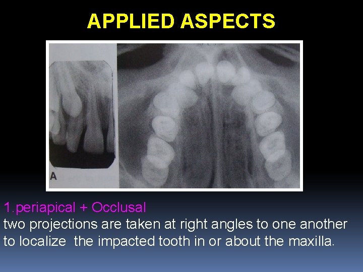 APPLIED ASPECTS 1. periapical + Occlusal two projections are taken at right angles to