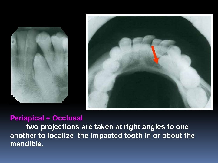 Periapical + Occlusal two projections are taken at right angles to one another to