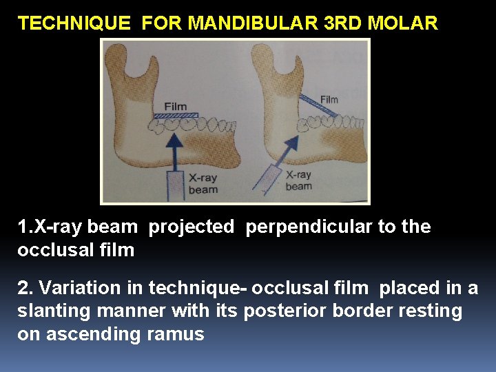 TECHNIQUE FOR MANDIBULAR 3 RD MOLAR 1. X-ray beam projected perpendicular to the occlusal