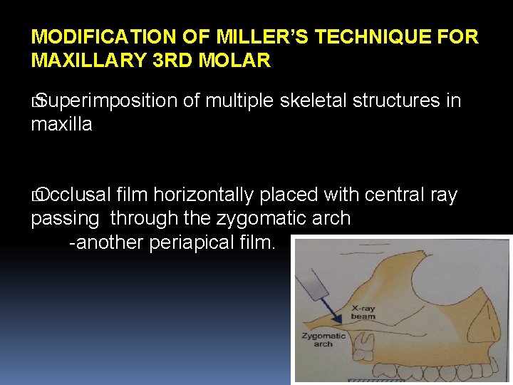 MODIFICATION OF MILLER’S TECHNIQUE FOR MAXILLARY 3 RD MOLAR � Superimposition of multiple skeletal