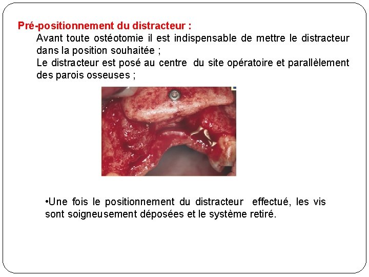 Pré-positionnement du distracteur : Avant toute ostéotomie il est indispensable de mettre le distracteur