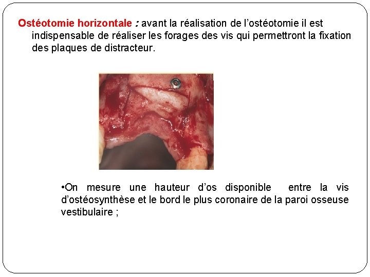 Ostéotomie horizontale : avant la réalisation de l’ostéotomie il est indispensable de réaliser les