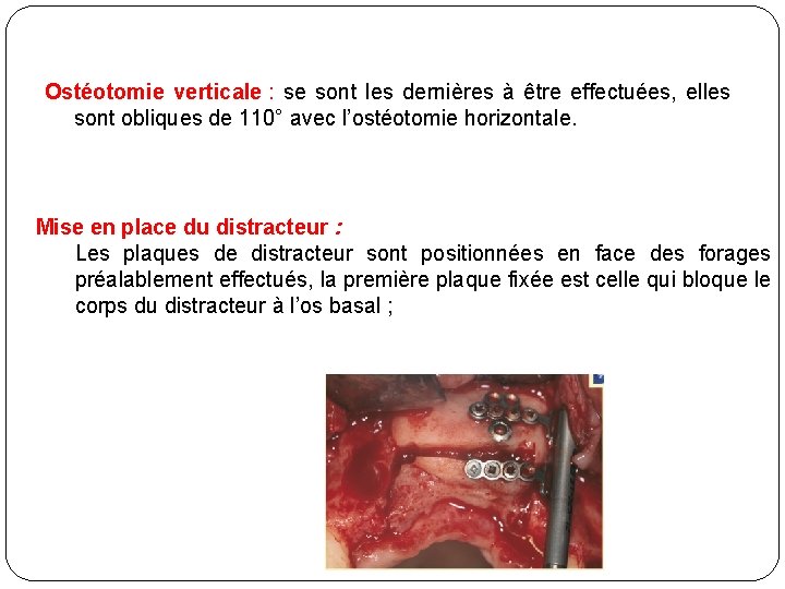 Ostéotomie verticale : se sont les dernières à être effectuées, elles sont obliques de