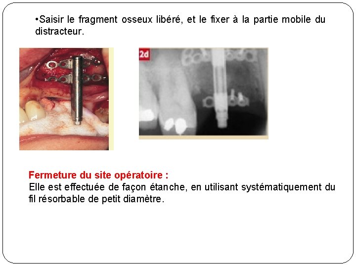  • Saisir le fragment osseux libéré, et le fixer à la partie mobile