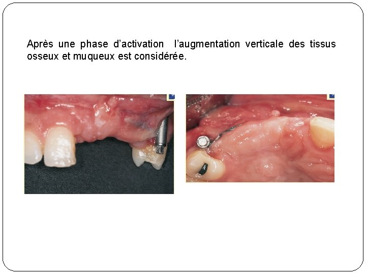 Après une phase d’activation l’augmentation verticale des tissus osseux et muqueux est considérée. 
