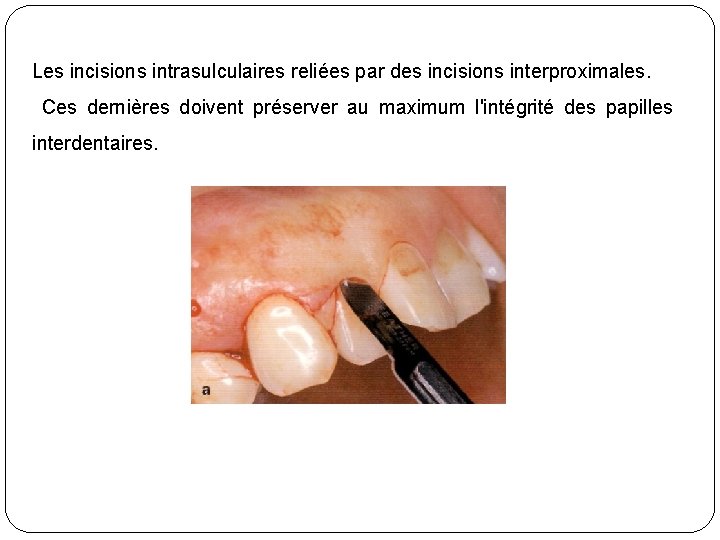 Les incisions intrasulculaires reliées par des incisions interproximales. Ces dernières doivent préserver au maximum