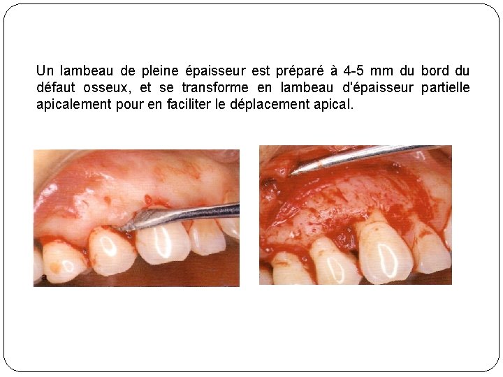 Un lambeau de pleine épaisseur est préparé à 4 -5 mm du bord du