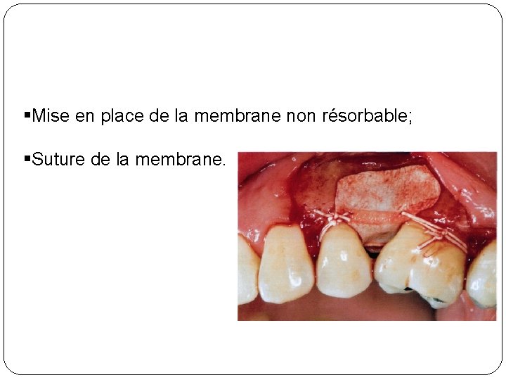§Mise en place de la membrane non résorbable; §Suture de la membrane. 