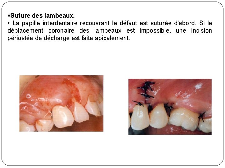 §Suture des lambeaux. • La papille interdentaire recouvrant le défaut est suturée d'abord. Si