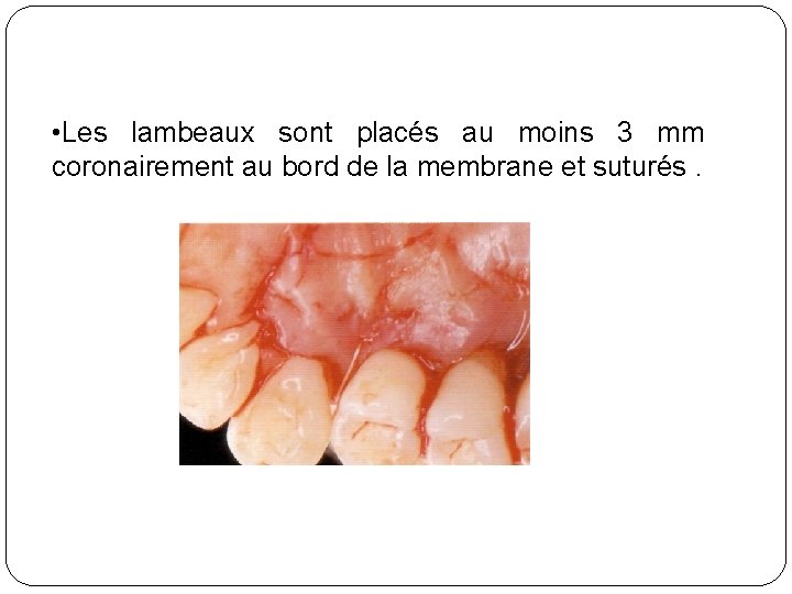  • Les lambeaux sont placés au moins 3 mm coronairement au bord de