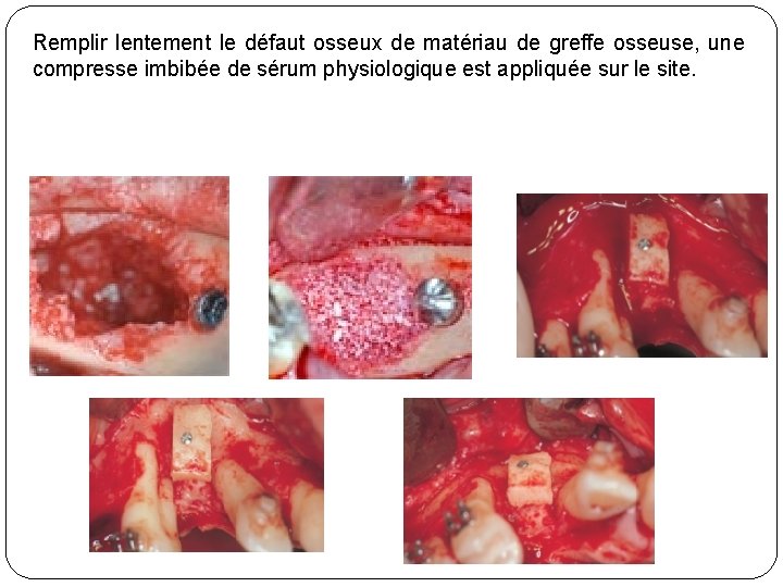 Remplir lentement le défaut osseux de matériau de greffe osseuse, une compresse imbibée de