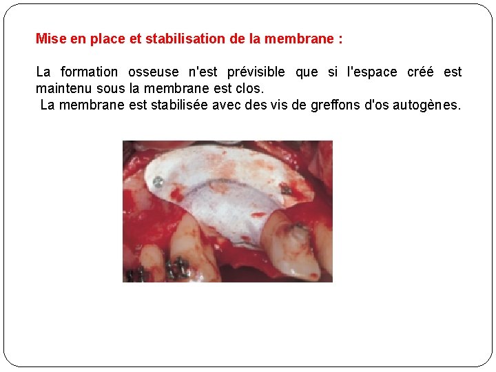 Mise en place et stabilisation de la membrane : La formation osseuse n'est prévisible